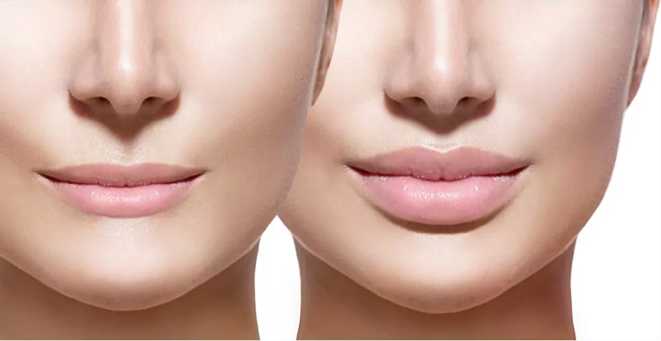 improved lip shape