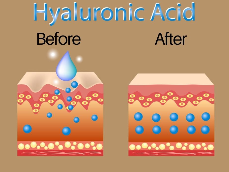 hyaluronic acid