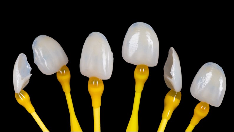dental veneer restorations