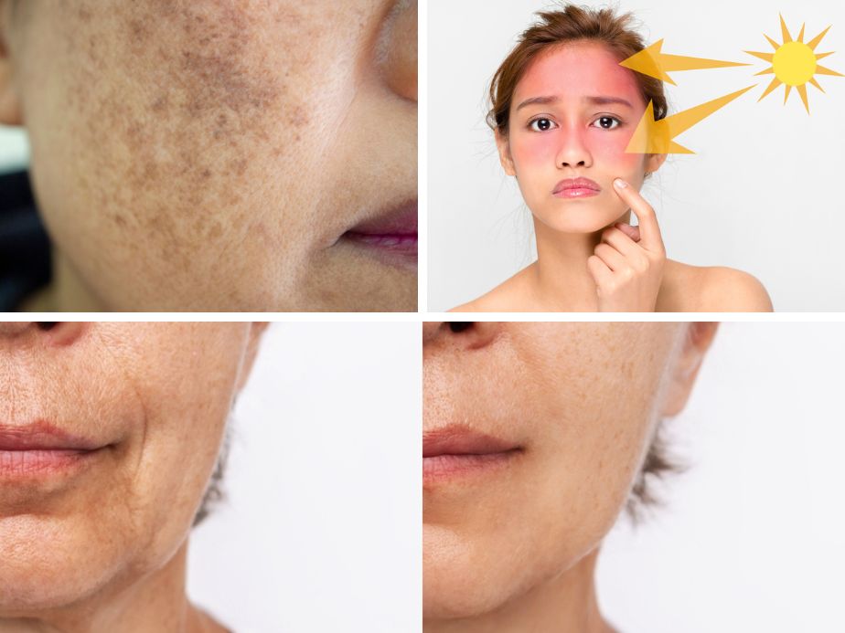 skin ageing wrinkles pigmentation sunburn