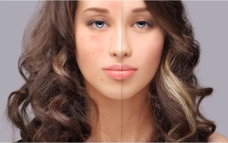 comparison of pimple marks before and after on a girl's face