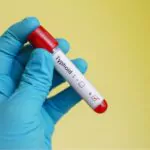 typhoid fever test