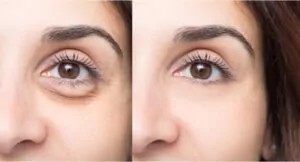 comparison of wrinkles under eye before and after