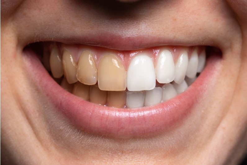 before and after view of teeth whitening