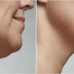 double chin fat before and after