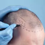patient suffering from hair loss in consultation with a doctor