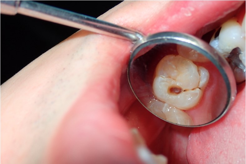 a dental tooth decay cavity found during routine dental examination