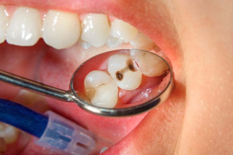 dental filling with dental composite photopolymer material